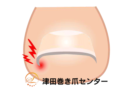 巻き爪矯正の図解